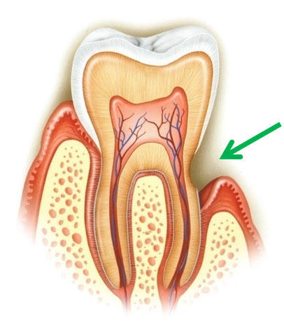 Gingival Graft Tooth