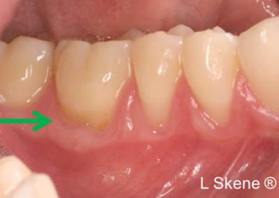 gum graft before