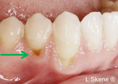gum graft before