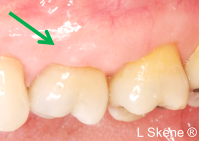 gum graft after