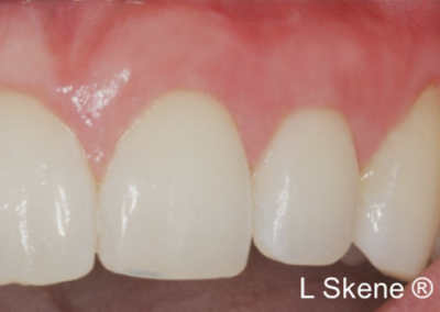 gum graft after