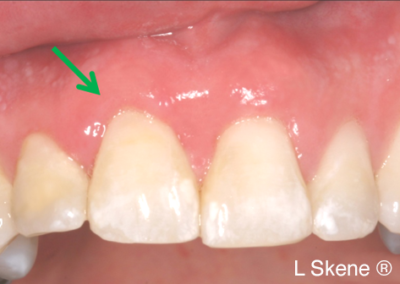 gum graft after