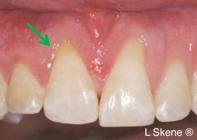 gum graft before