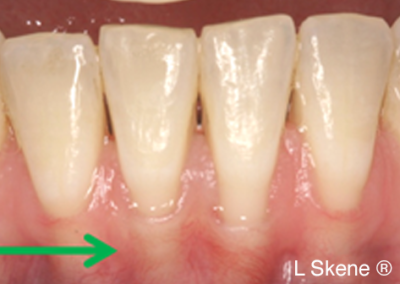 gum graft before