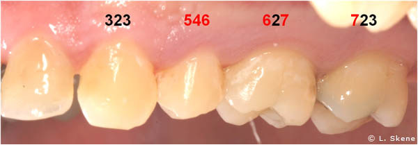 Gum Recession Before Osseous Surgery in Salt Lake City