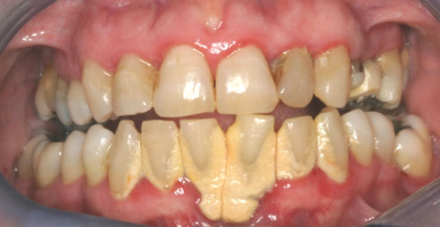 Severe Periodontal Disease