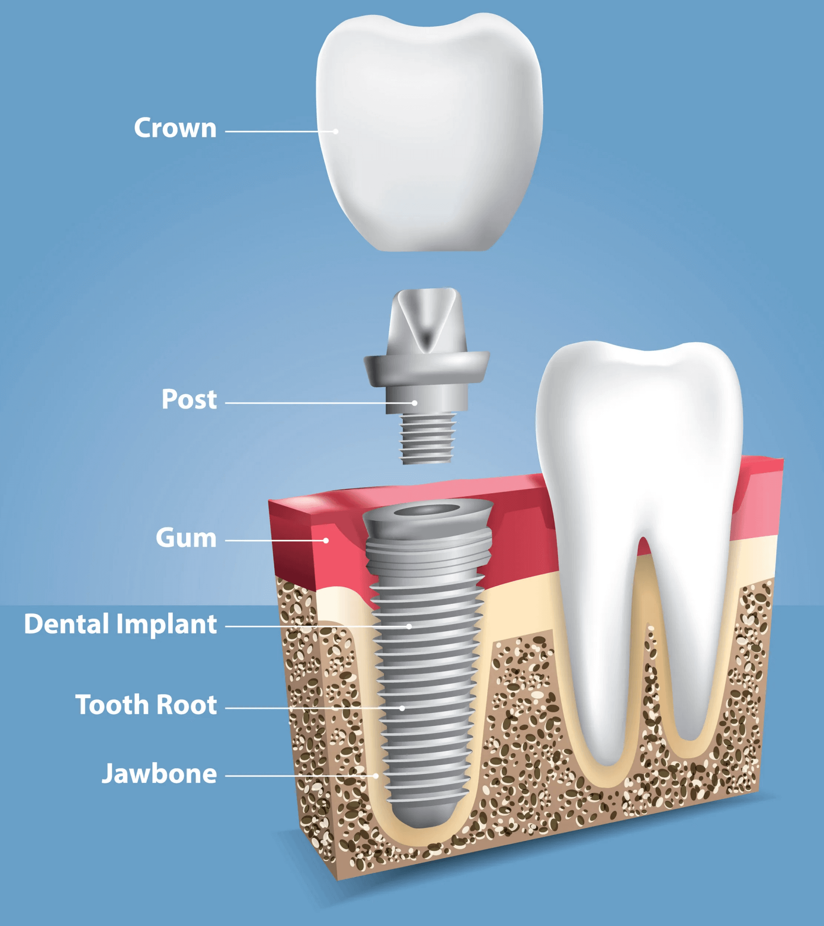 Showing the Crown, Post, Gum, Dental Implant, Tooth Root, and Jawbone in the mouth