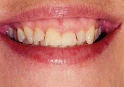 Teeth Before Crown Lengthening