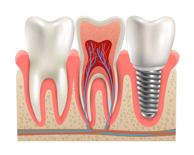 Three Types of Dental Implants