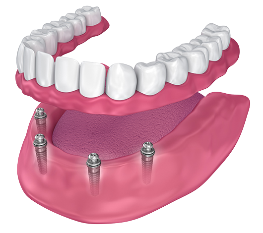 Dental Implants With Screws