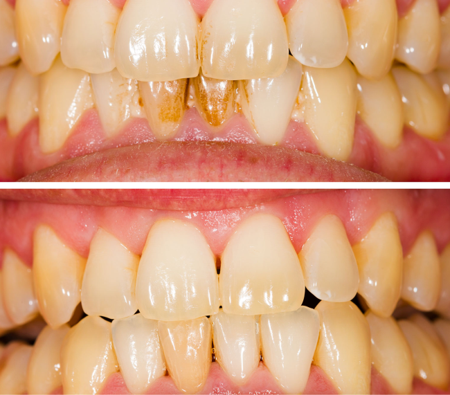 Before and After Scaling and Root Planing in Salt Lake City UT