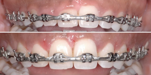 Gingivectomy With Braces