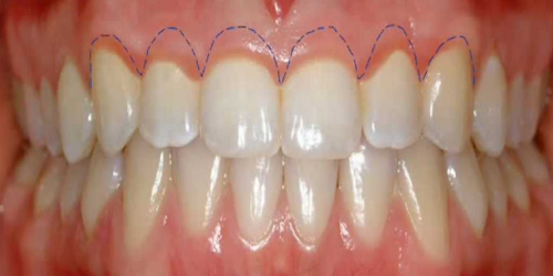 Gingivectomy With Lines On Gums