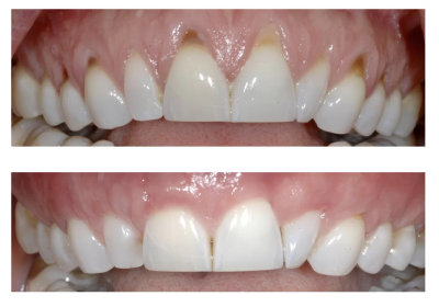 Gingival Graft Tooth