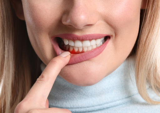 Girl With Bleeding Gums