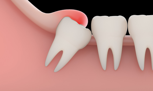 Impacted Tooth Exposure Image