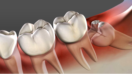 Impacted Tooth