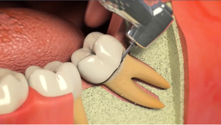 Impacted Tooth Exposure Treatment in Salt Lake City
