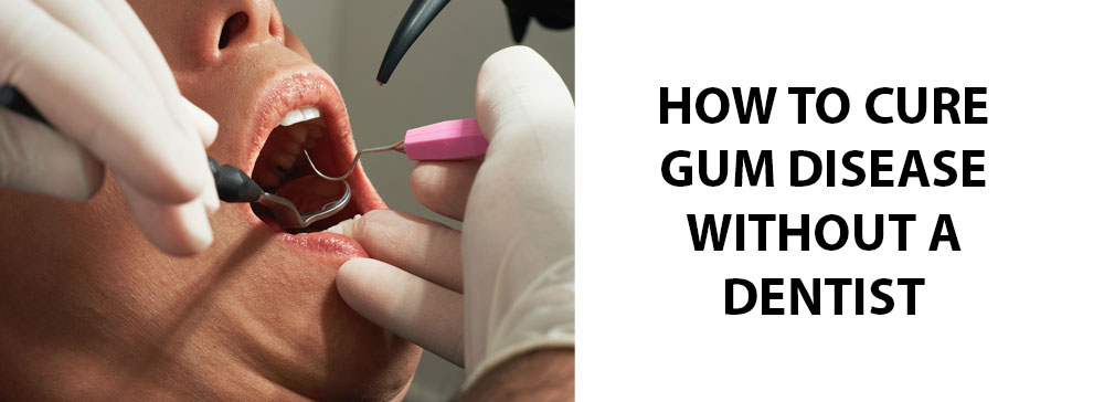 How To Cure Gum Disease Without A Dentist