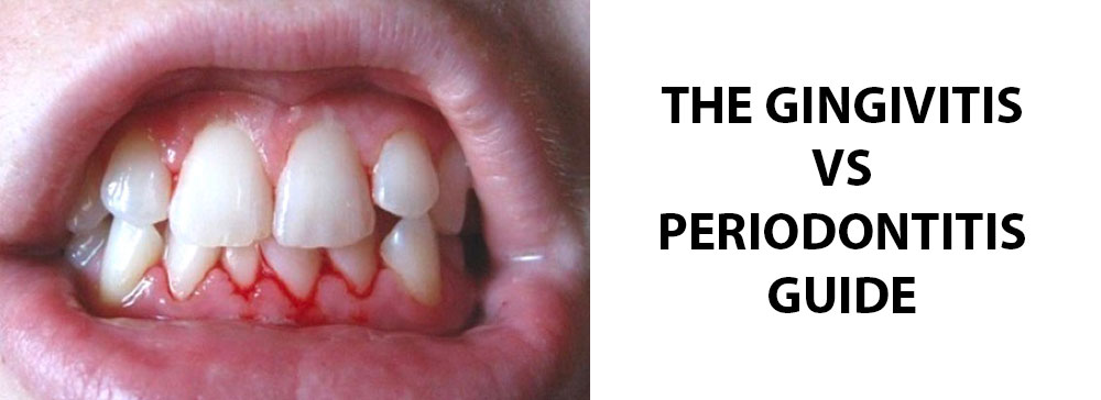 The Gingivitis vs Periodontitis Guide