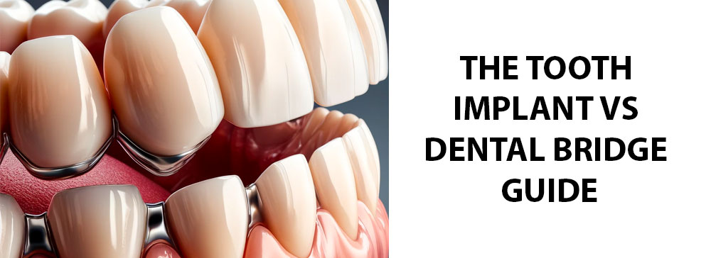 The Tooth Implant vs Dental Bridge Guide: Which is Better?