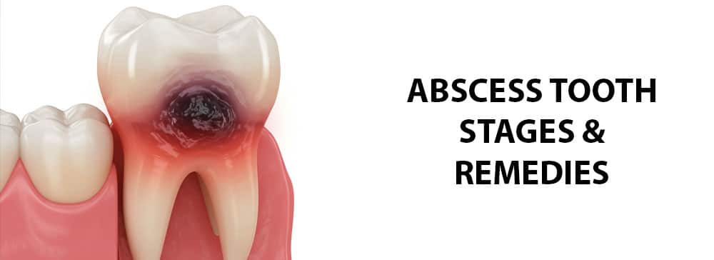 The Guide To Abscess Tooth Stages & Remedies