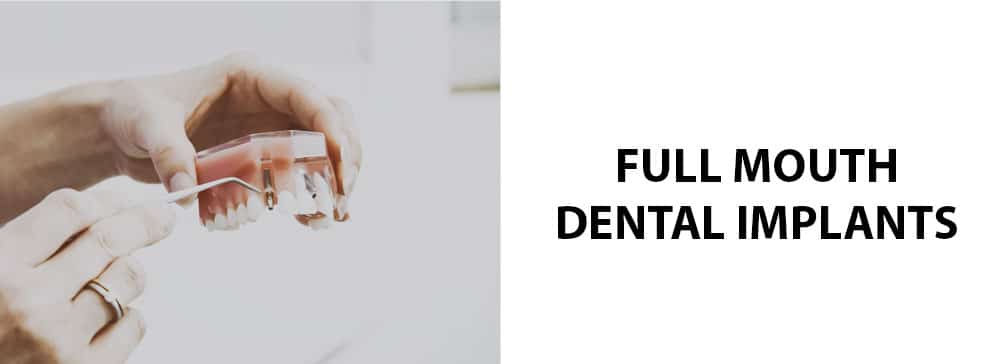 Full Mouth Dental Implants