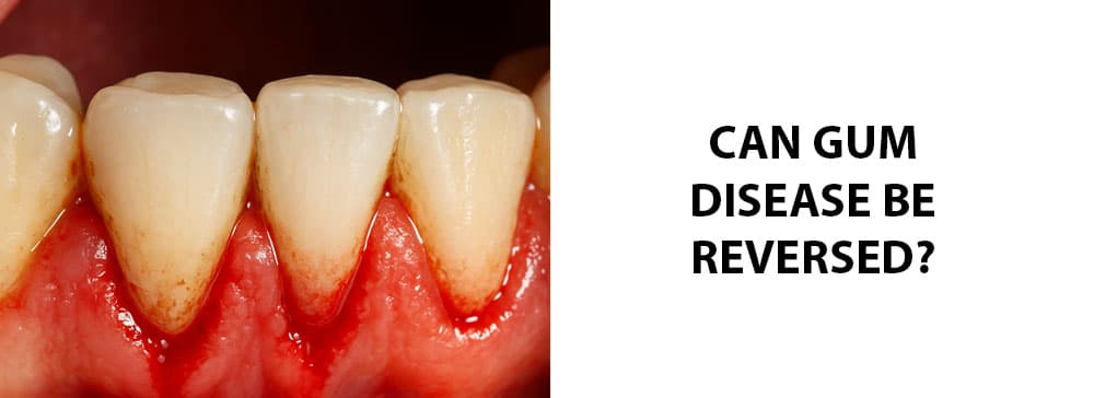 Can Gum Disease Be Reversed?