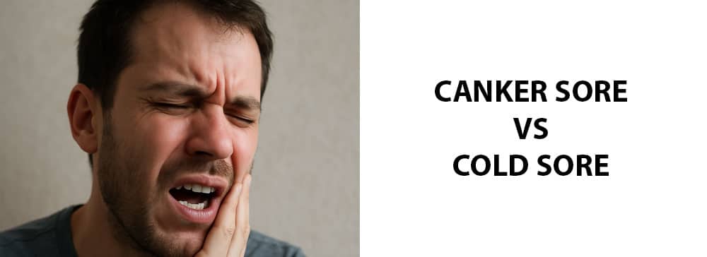 Canker Sore vs Cold Sore