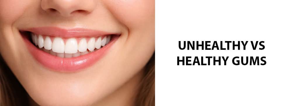 Healthy vs Unhealthy Gums