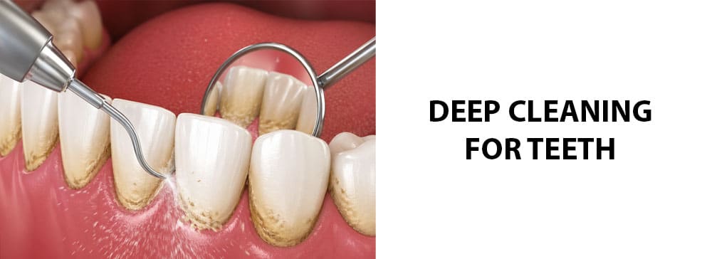 Deep Cleaning For Teeth