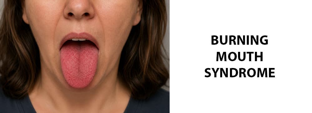 Burning Mouth Syndrome