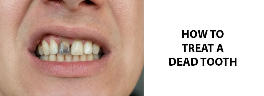 How To Treat A Dead Tooth