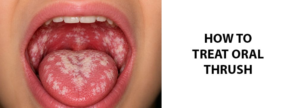 The Oral Thrush Guide: Causes, Symptoms, & Treatments