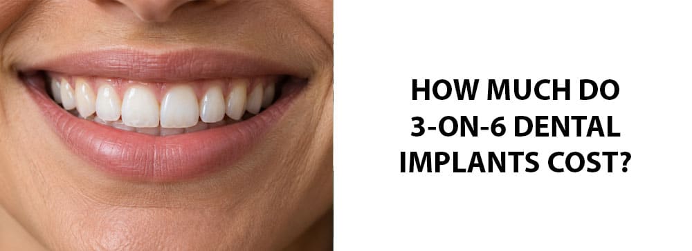 How Much Do 3-on-6 Dental Implants Cost?